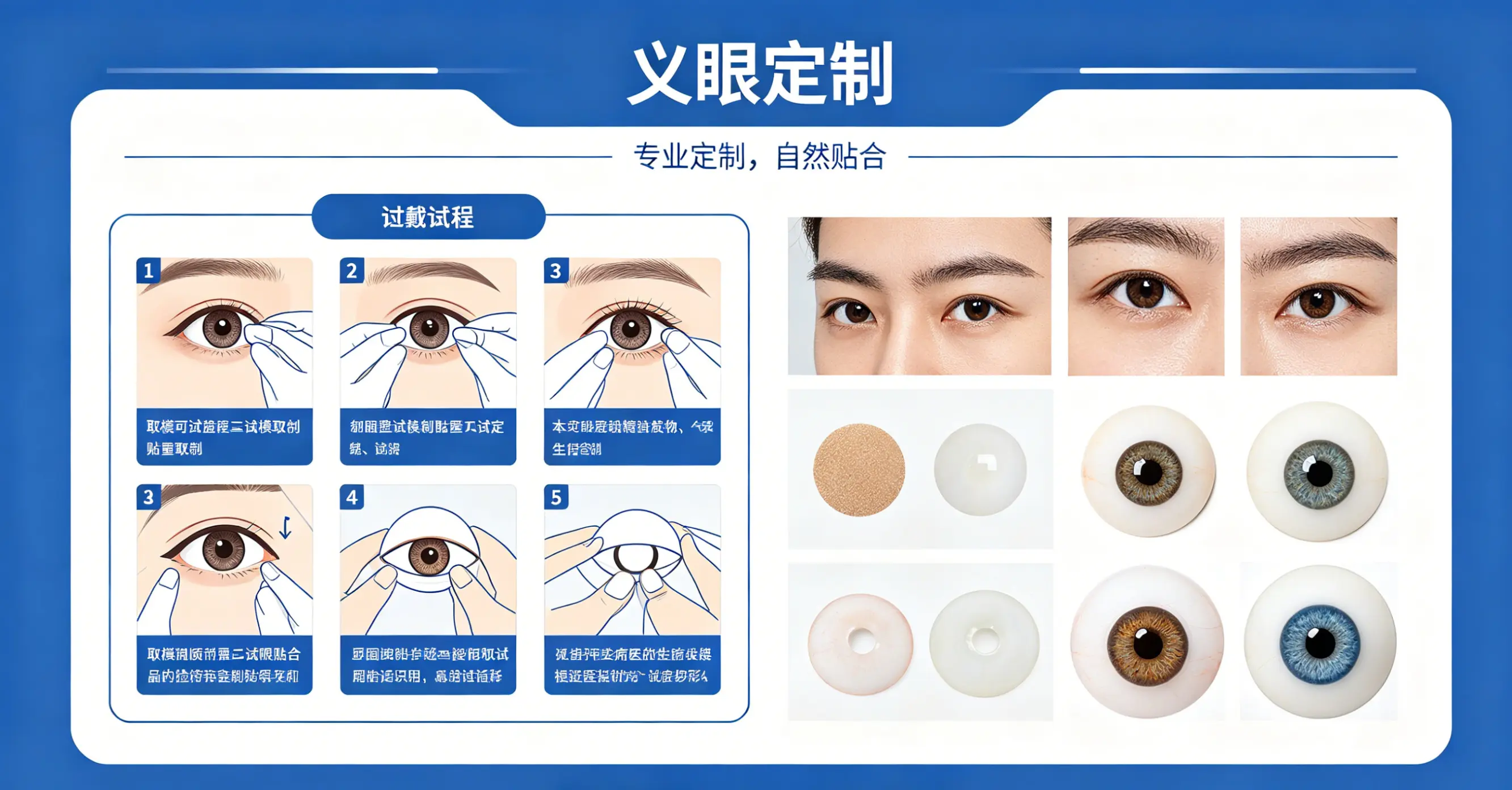 2026年义眼安装指南：除了传统义眼，这几种修复方案你知道吗？